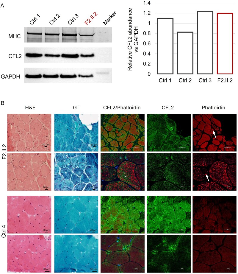 Novel missense variants in CFL2 affect F-actin depolymerisation and expand the disease spectrum of CFL2-related myopathy.