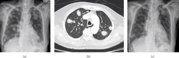 Thyroid Fibrosarcoma as a Rare Differential Diagnosis of Anaplastic Thyroid Cancer: A Case Report.