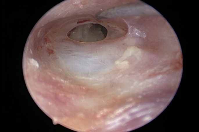 Thermal injury in endoscopic ear surgery between reality and fiction.