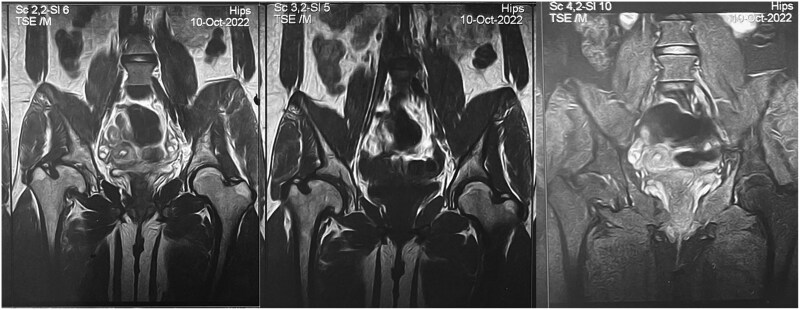 Avascular necrosis as an uncommon manifestation in glycogen storage disease type III: diagnostic and therapeutic challenges.