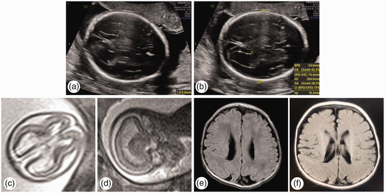 Beneath a silent attack: Unraveling lung and brain injuries in a surviving monoamniotic twin.