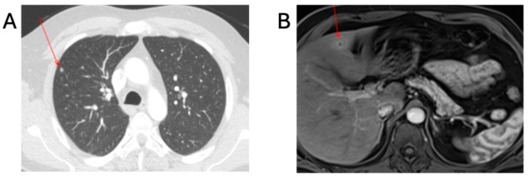 A Family Cluster of Imported Human <i>Brucella melitensis</i> Infection with Probable Breast Milk Transmission: A Case Series.