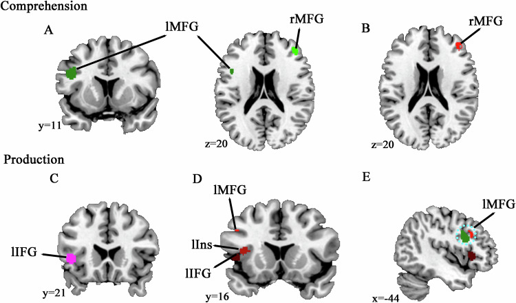 Unraveling consistently altered brain activations of language deficits in schizophrenia: evidence from ALE meta-analysis.