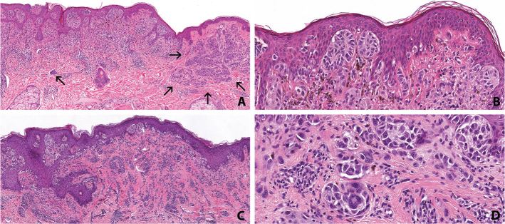 POT1 genetic testing in melanoma-prone families in Sweden: germline variant prevalence and tumor spectrum in identified carriers.