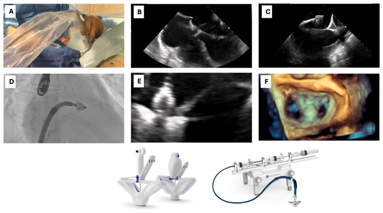Functional Mitral Regurgitation in the Transcatheter Era: Diagnostic and Therapeutic Pathways.