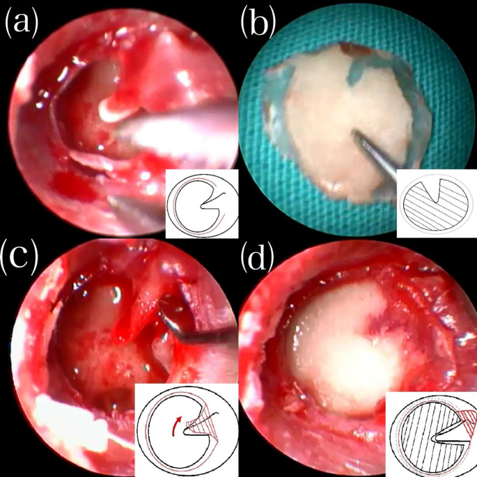 Preliminary results of a new endoscopic underlay cartilage tympanoplasty with lateral malleolar flap.