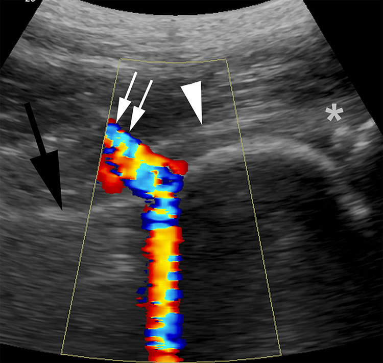 Effectiveness of Ultrasound Guided Intraarticular Injections with Lidocaine and Triamcinolone: A Retrospective Study of Primary Hip Injections.