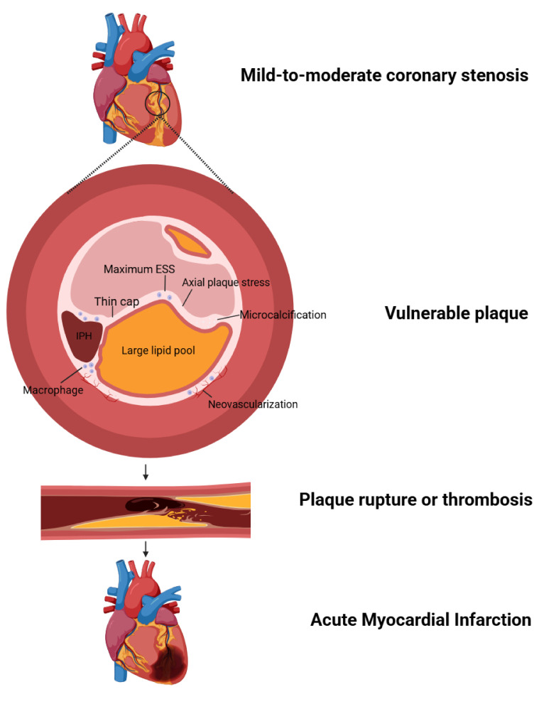 Current Advancements in the Diagnosis and Management of Mild-to-moderate Coronary Stenosis.