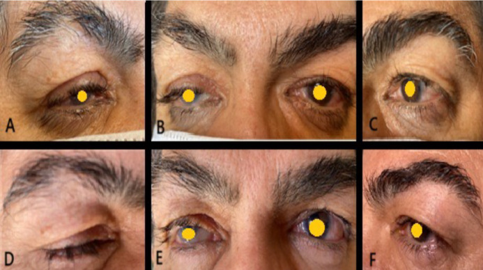 Oculoplastic Challenges in Patients with Glaucoma.