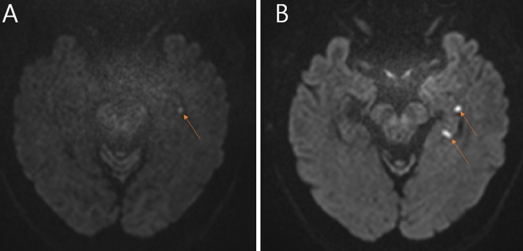 Dizziness and spatial disorientation in patients with transient global amnesia: clinical and vestibular correlates.
