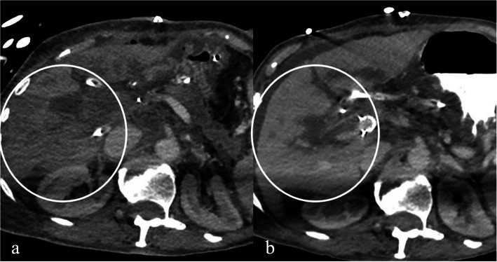 Portal vein stent to save the day.