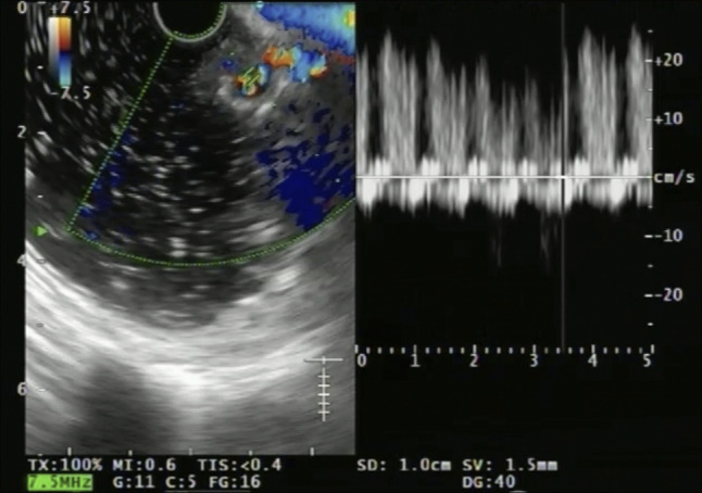 Expanding Horizons of Vascular Interventions: Endoscopic Ultrasound-Guided Angioembolization for a Refractory Upper Gastrointestinal Bleed From a Gastric Dieulafoy Lesion.