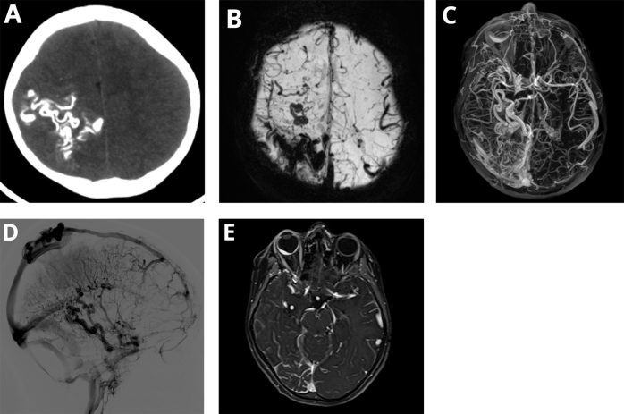 Sturge-Weber syndrome Type I: a rare case report.