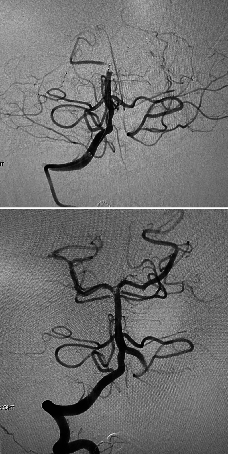 Recurrent basilar artery thrombectomy for pediatric vertebral dissection: illustrative case.