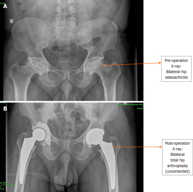Single staged bilateral total hip replacement and its outcomes: A cross-sectional study.