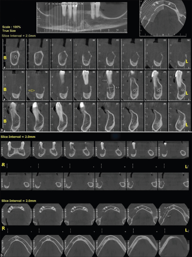 Metastasis of follicular carcinoma of the thyroid gland to the mandible: A report of a rare case.