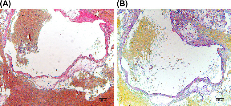 Fatal Umbilical Cord Hemorrhage Triggering Neonatal Demise: Clinicopathological Insights from the Case Analysis.