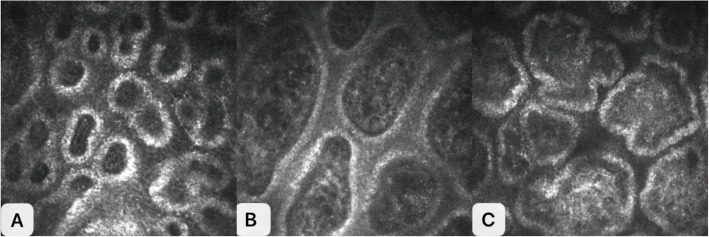 Analysis of the correlation between corneal and meibomian gland morphology and glycated hemoglobin levels in type 2 diabetes patients.