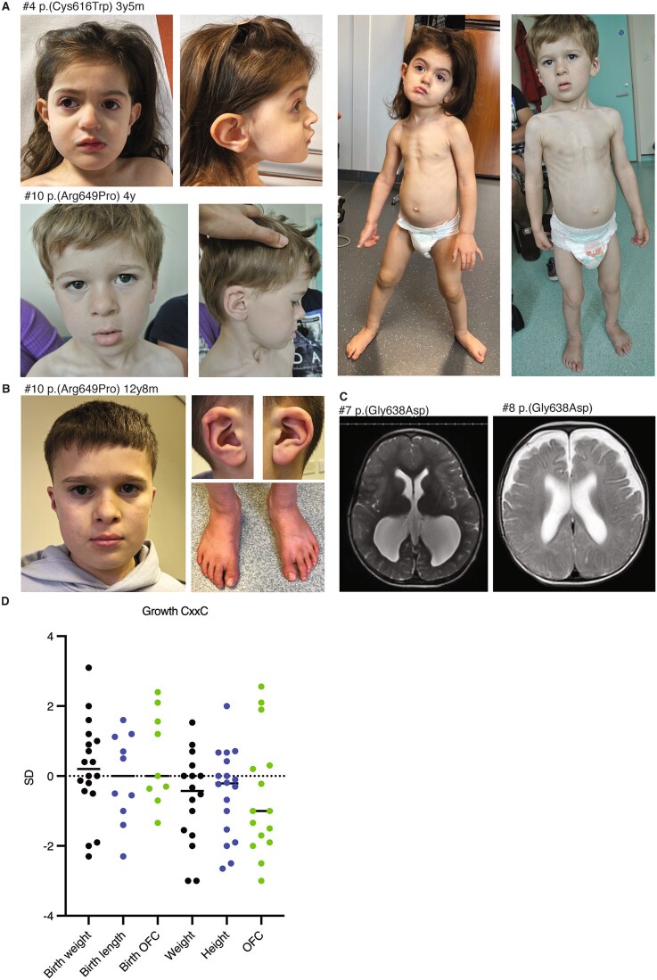 KDM2B variants in the CxxC domain impair its DNA-binding ability and cause a distinct neurodevelopmental syndrome.