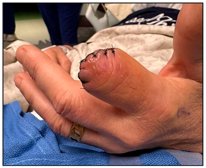 The First <i>Schaalia</i> (Formerly <i>Actinomyces</i>) <i>Canis</i>-Related Osteomyelitis Requiring Surgical Intervention.