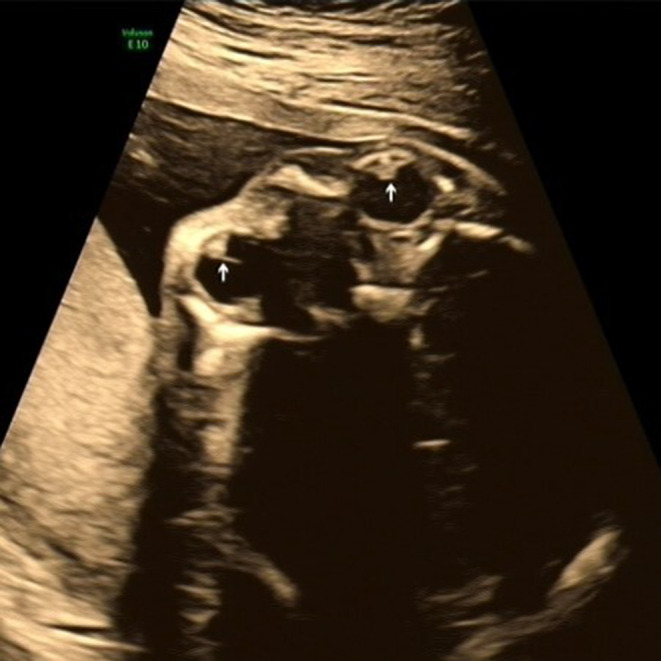 Prenatal Ultrasound Diagnosis and Prognosis Analysis of Fetal Congenital Cataract.