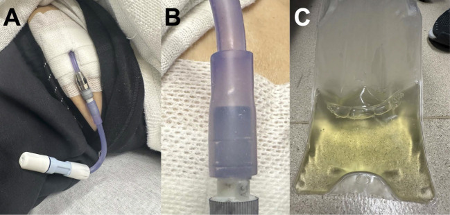 Asymptomatic Patient with ESKD Presenting with a Purple Peritoneal Dialysis Catheter.