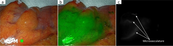 Clinical value of fluorescence laparoscopic surgery on anastomotic leakage prevention in ultra-low rectal cancer: real-world multicenter retrospective evidence with neoadjuvant chemoradiotherapy stratification.