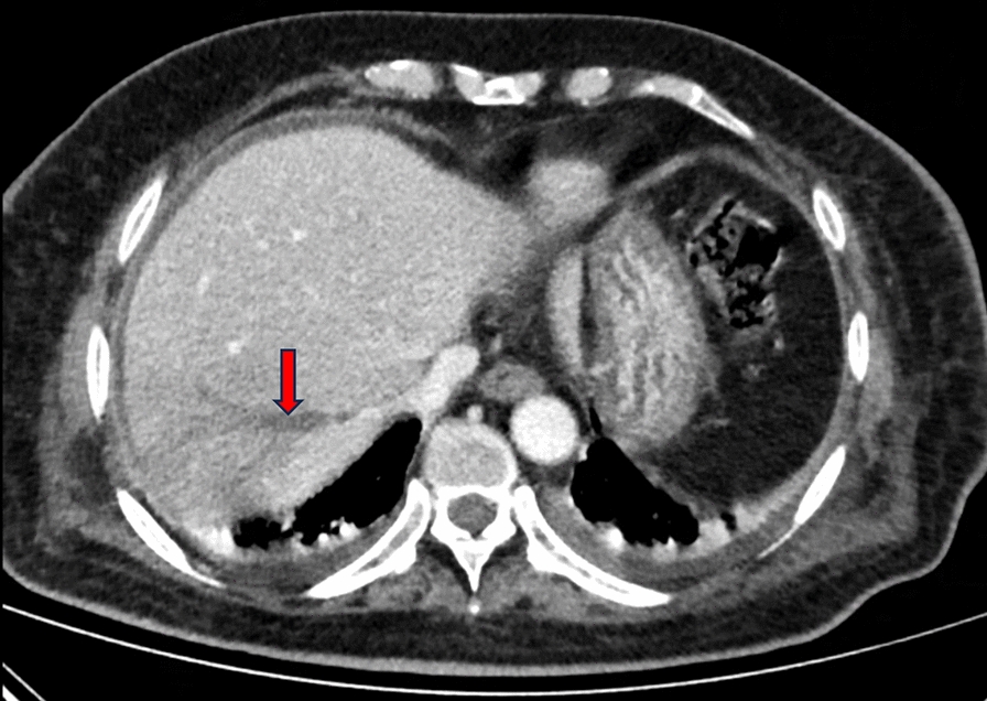 Treatment of liver abscess caused by Klebsiella pneumoniae with multi-site infection: a case report.