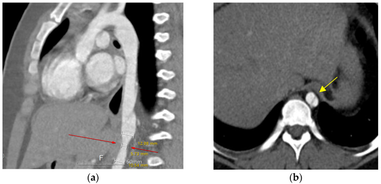 A Rare Case of Aortic Dissection 10 Years Post Percutaneous Catheterization Retrieval of an Embolized PDA Device in a Patient with Down Syndrome.