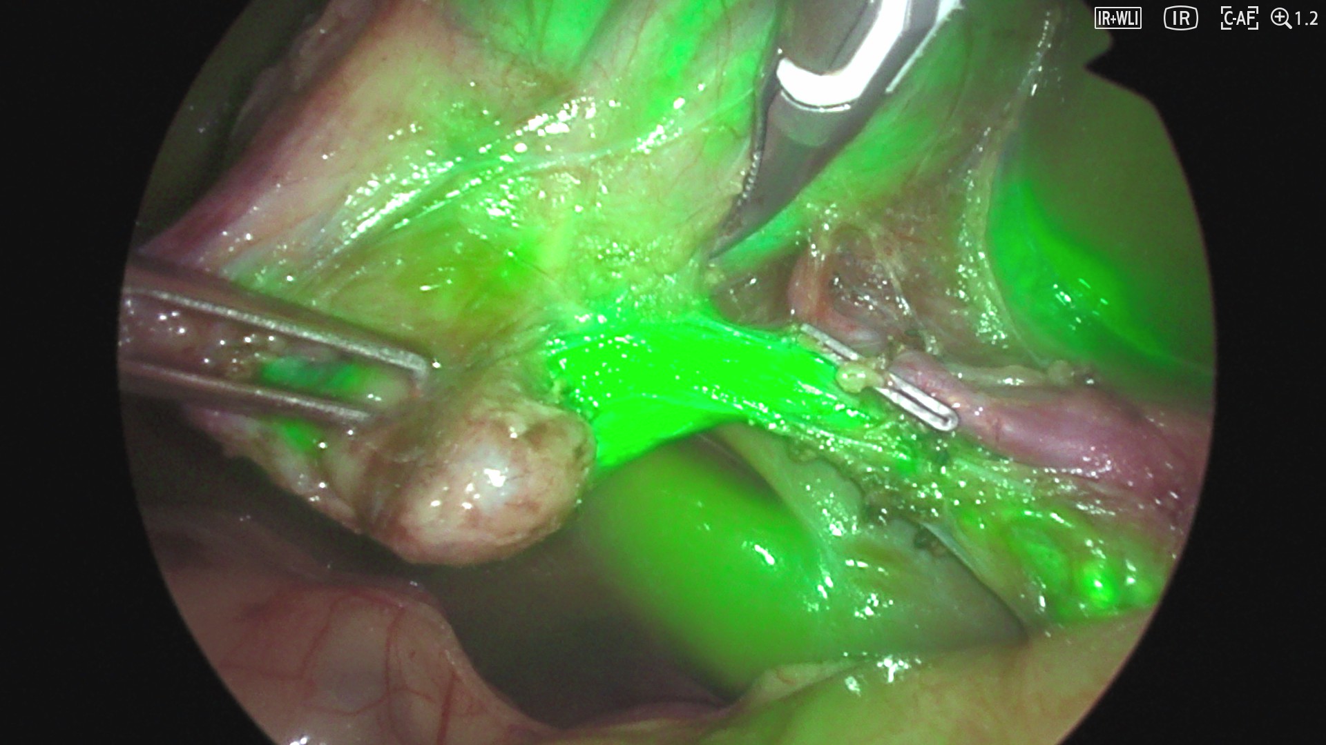 Short-interval intravenous indocyanine green administration in pediatric laparoscopic cholecystectomy: a prospective evaluation of visualization and safety.
