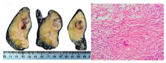 Addison's disease due to adrenal insufficiency in an immunocompetent patient with disseminated cryptococcosis. Case report.