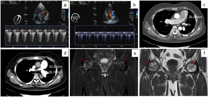 Severe pulmonary arterial hypertension development despite lupus nephritis remission: association with podocytic infolding glomerulopathy.