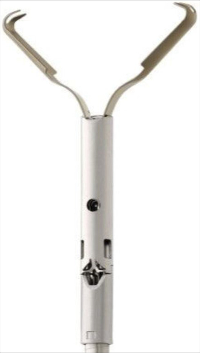 Endoscopic Treatment of a Colovesical Fistula Using a Through-The-Scope Clip Designed for Large Defect Closure.