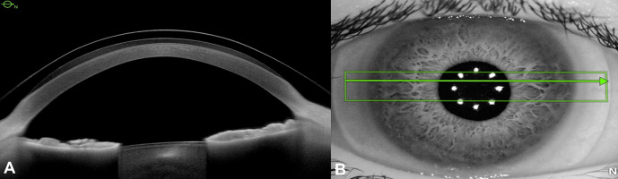 Spectrum of Scleral Lens Fit and Patient Compliance: A Single Center Retrospective Study.