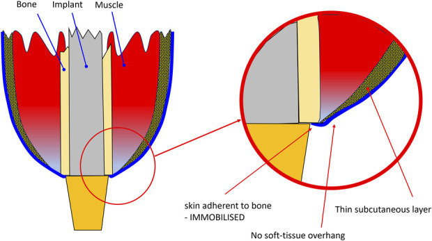 Use of a "Fascial-Sock" Technique to Manage the Stump and Stoma After Insertion of an Osseointegrated Implant in Transfemoral Amputees.