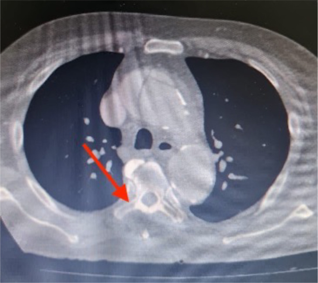 Spontaneous Aortic Sealing with Tranexamic Acid in Type A Dissection: A Novel Life-Saving Finding.