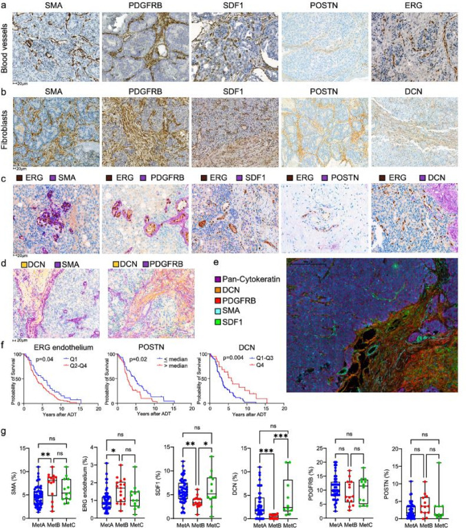Morphological heterogeneities in prostate cancer bone metastases are related to molecular subtypes and prognosis.