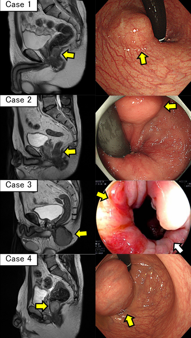 Partial resection of rectum for rectal GIST by posterior approach.