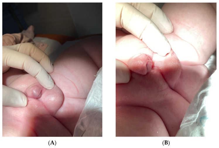 A Case Report of Tissue Mosaicism in 45,X0/46,XY: Diagnostic Complexity in a Newborn with Ambiguous Genitalia.