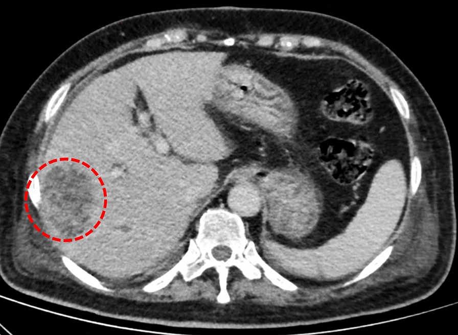 Treatment of liver abscess caused by Klebsiella pneumoniae with multi-site infection: a case report.