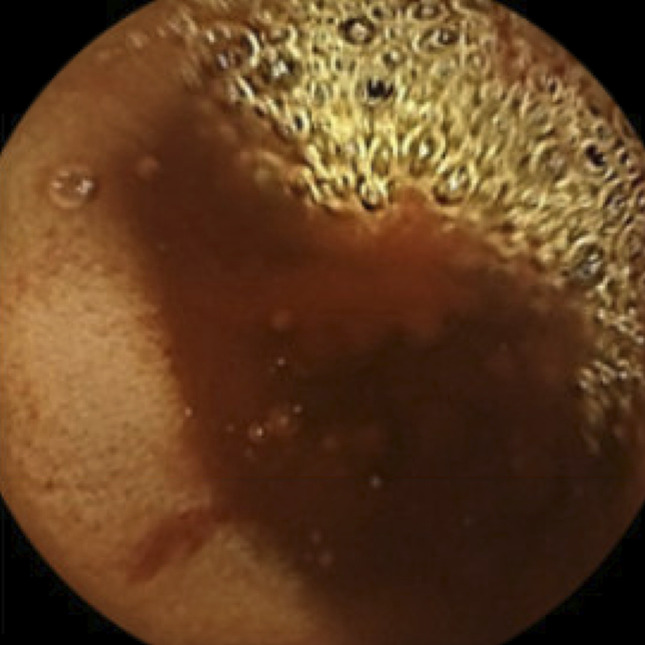 Primary Jejunal Angiosarcoma.