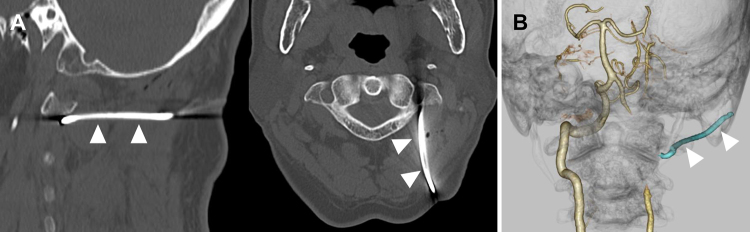 Distal and proximal embolization for penetrating vertebral artery injury: illustrative case.