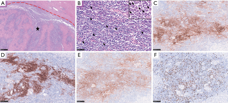 Primary Epstein-Barr virus-positive inflammatory follicular dendritic cell sarcoma concurrent with lymphoepithelioma-like intrahepatic cholangiocarcinoma and cavernous hemangioma in liver.