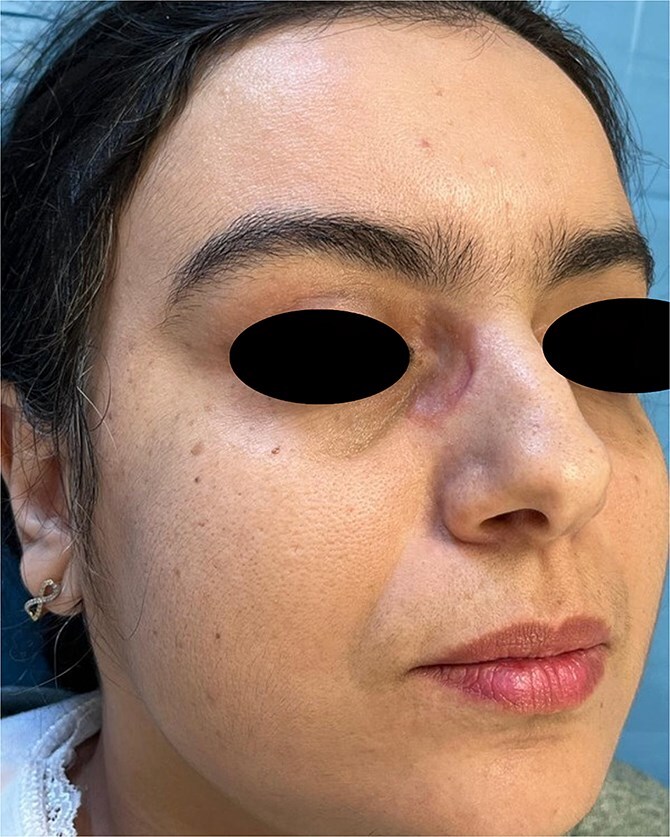An unusual presentation of cutaneous sarcoidosis induced by Koebner's phenomenon.