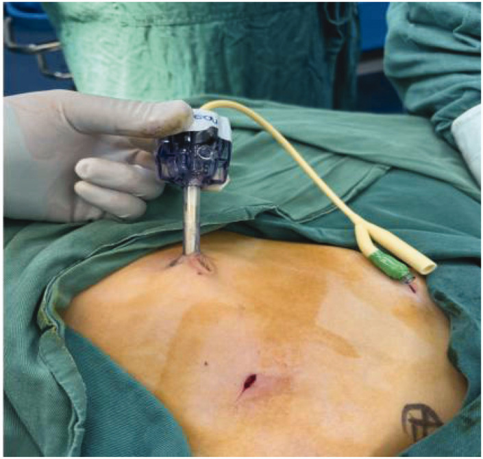 The balloon technique for trocar-site closure: Description of a novel technique along with a literature review.