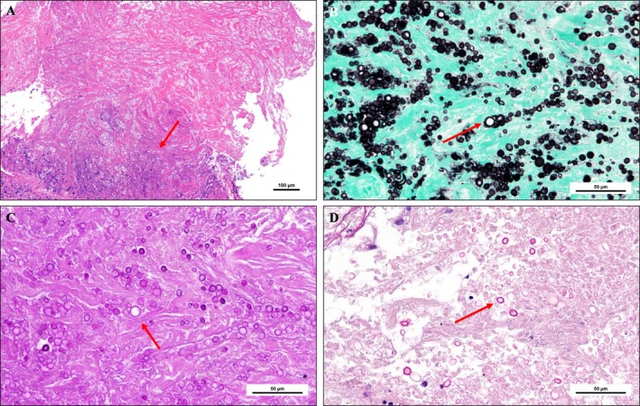 Pulmonary Cryptococcosis With Rapid Growth on Positron Emission Tomography/Computed Tomography.