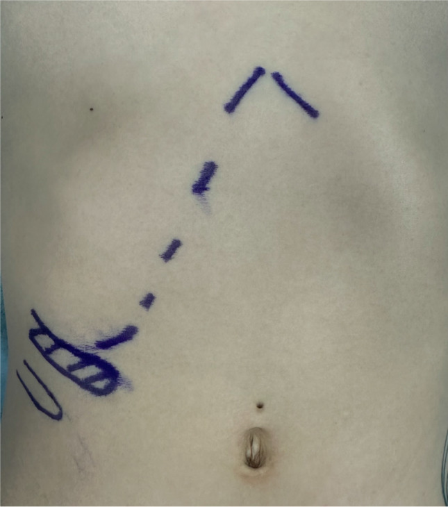 Minimally invasive surgical approach for slipping rib syndrome: A case report.