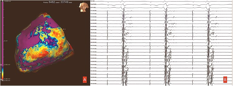 Epicardial ablation of ventricular tachycardia in a patient with dilated cardiomyopathy due to Becker muscular dystrophy: a case report.