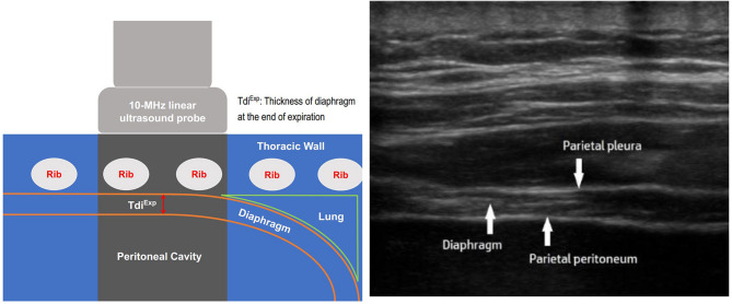 A novel methodology for measuring global diaphragm thickness by ultrasonography in patients with critical illness: an exploratory pilot study.