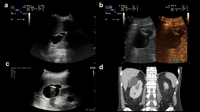 The value of contrast-enhanced ultrasound in the follow-up of Bosniak IIF cystic renal lesions.